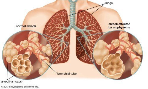 Lung disease