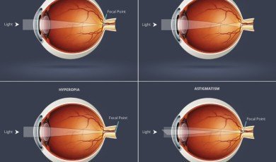 Refractive Errors